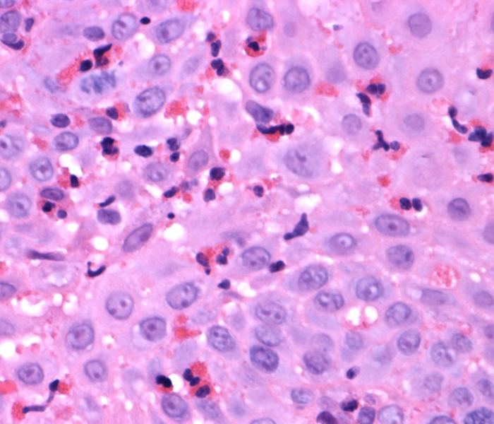 Biopsy demonstrating eosinophilic oesophagitis Biopsy demonstrating eosinophilic oesophagitis - AHLab