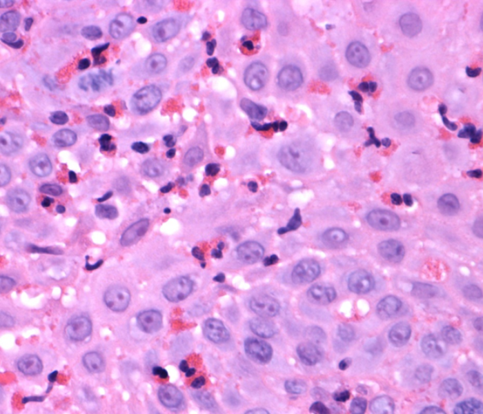 Biopsy demonstrating eosinophilic oesophagitis - AHLab