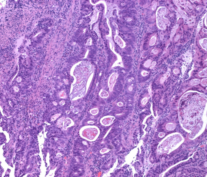 High power image of bowel tumour - AHLab
