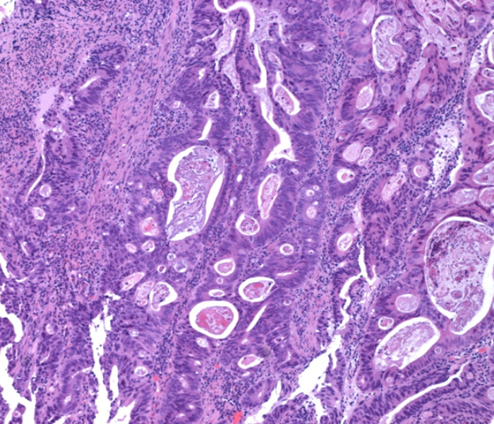High power image of bowel tumour High power image of bowel tumour - AHLab