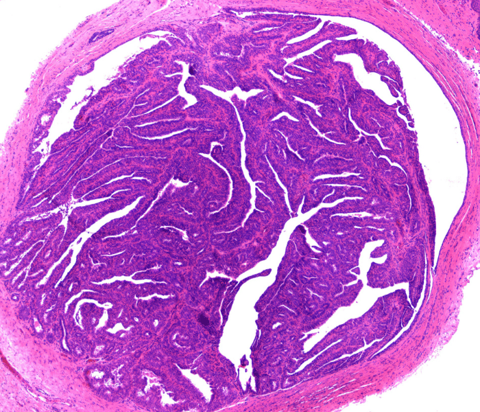 Dermatology - hidradenoma from hidradenoma - AHLab
