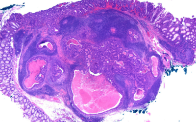 Importance of Diagnosing Bowel Cancer